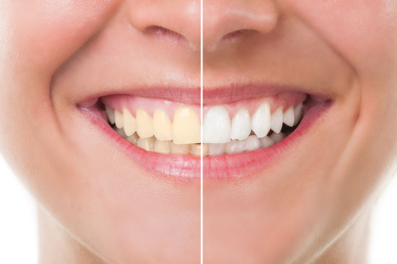 Teeth Whitening in Sarasota